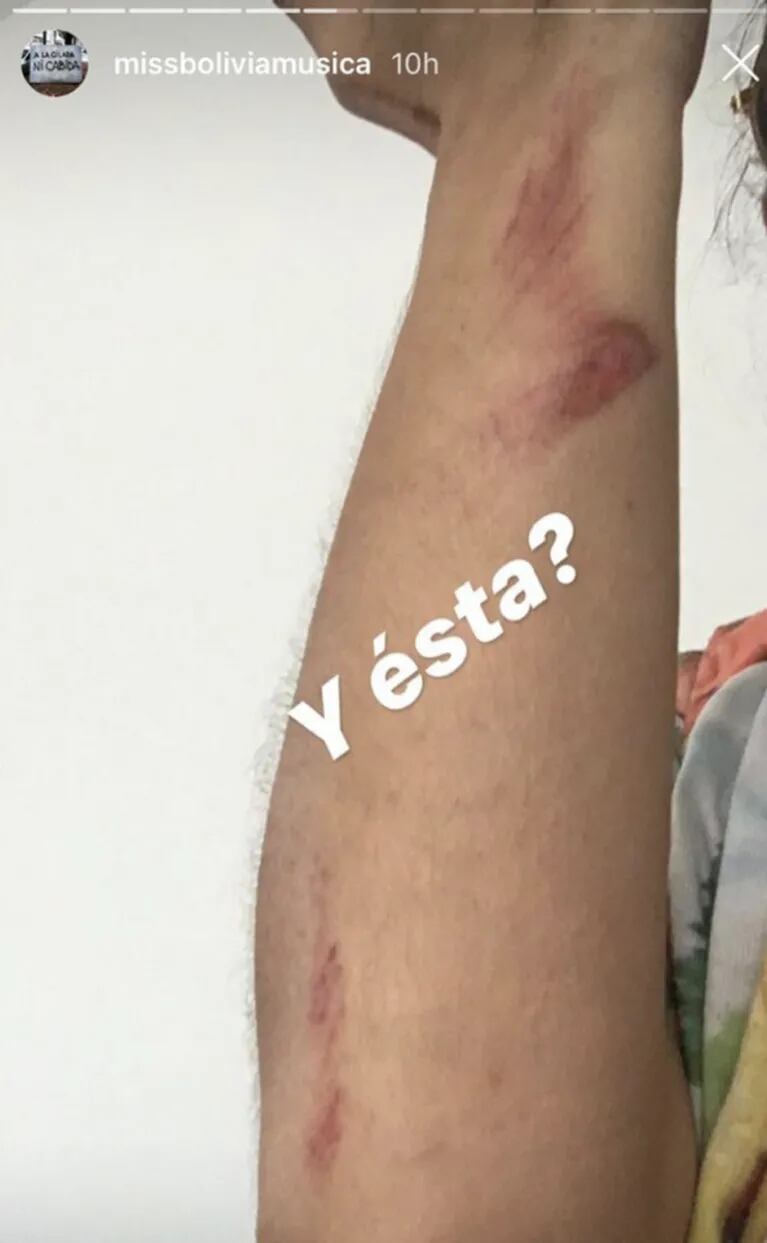 Miss Bolivia se separó de su marido: contó que sufrió violencia de género y mostró heridas en sus brazos