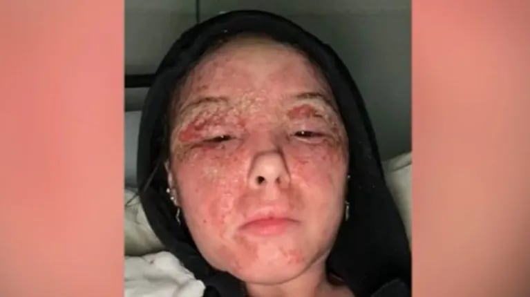 Esta joven revela cómo curó un eczema facial extremo