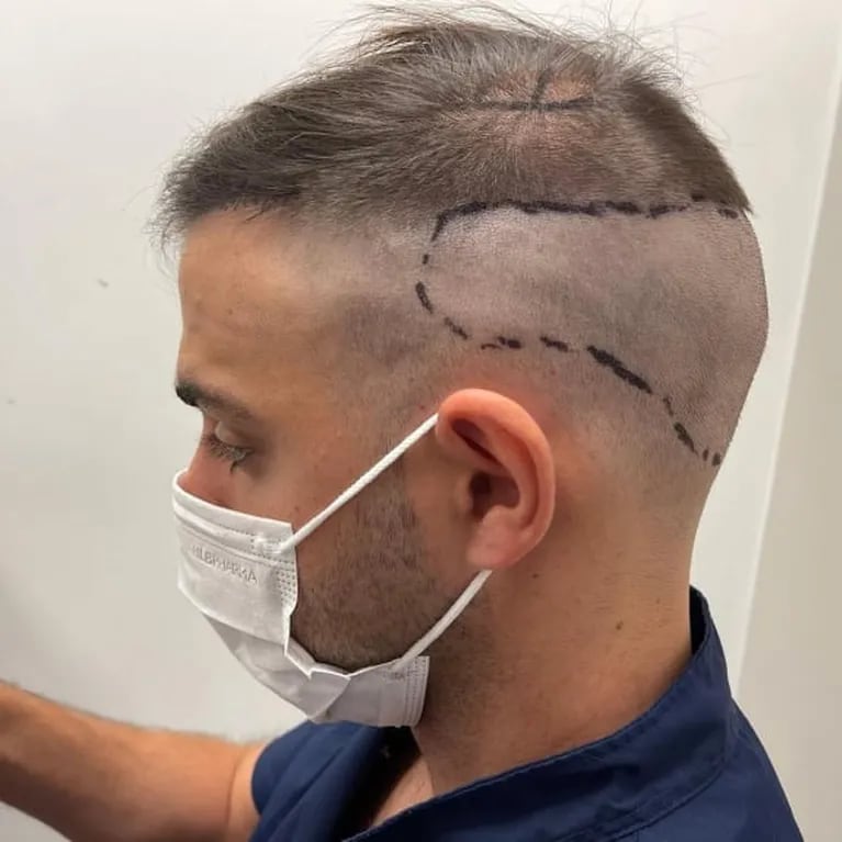 Grego Rossello se realizó un implante capilar, mostró todo el proceso y cómo quedó: "Le tenía cagazo al tema"