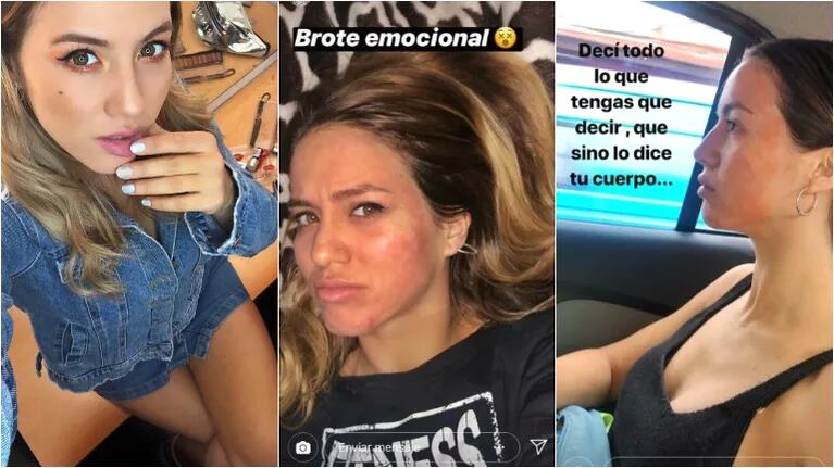 Fuertes publicaciones de Flor Vigna con la cara brotada (Fotos: Instagram y Captura de Instagram Stories)