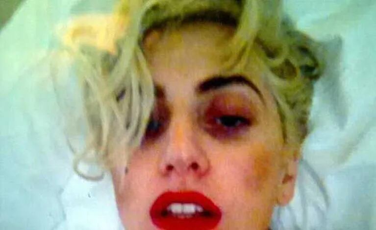 Lady Gaga con moretones, así quedó después del golpe en el show de Nueva Zelanda. (Foto: Web)