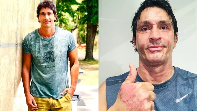 Sebastián Estevanez mostró cómo quedó su rostro tras explotarle un bidón de alcohol: Tengan mucho cuidado