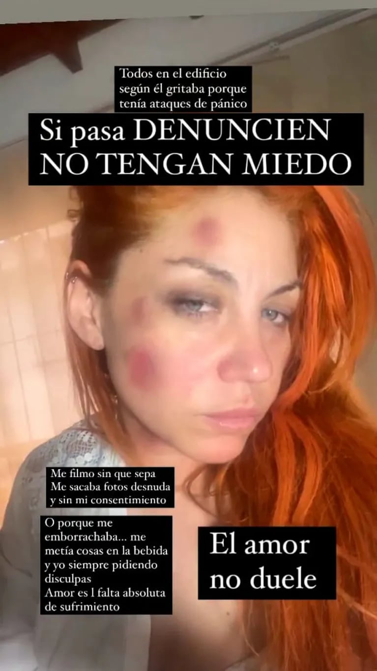 Lowrdez Fernández acusó a su novio de violencia de género y mostró las heridas