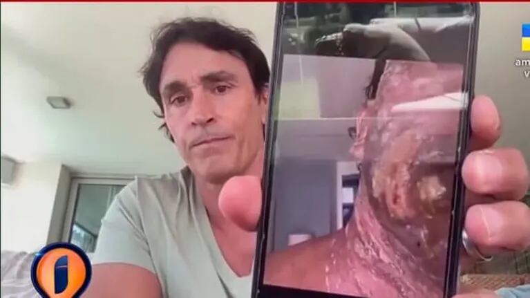Las impactantes fotos del rostro quemado de Sebastián Estevanez en carne viva, tras el accidente con un bidón de alcohol: "Quiero concientizar"
