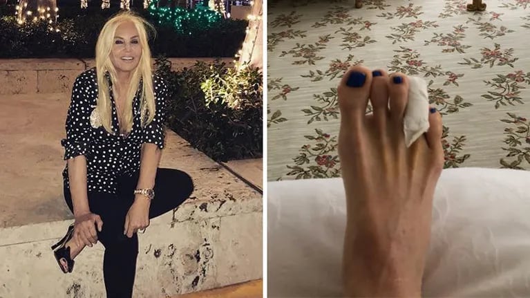 Susana Giménez se operó un dedo del su pie derecho, le sacó una foto y explicó por qué fue a cirugía