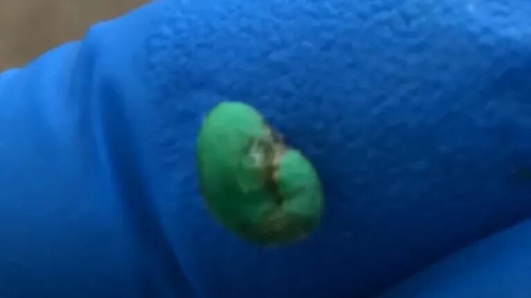 Un niño de ocho años acude al audiólogo y este termina extrayéndole un trozo de plastilina verde de su oído derecho