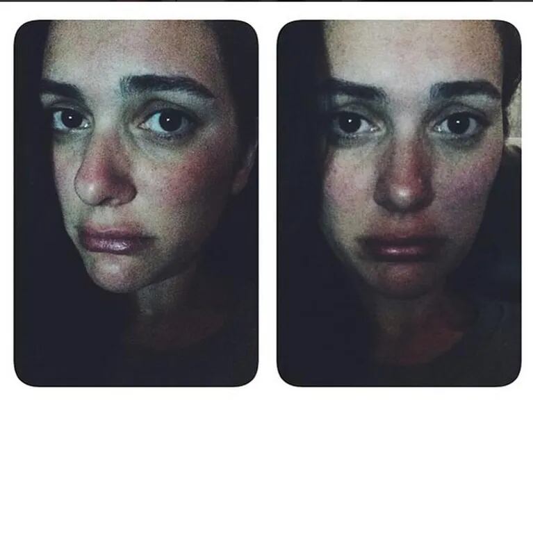 La alergia que mostró Sherezade en Instagram. 