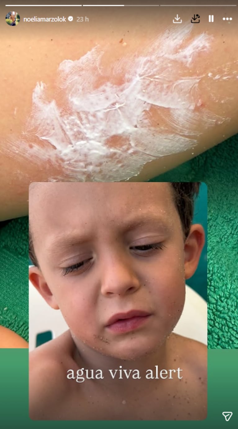 Al hijo de Noelia Marzol lo atacó un agua viva: la foto | Créditos: Instagram @noeliamarzolok