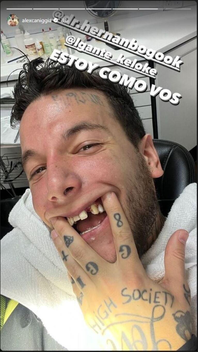 Alex Caniggia se burló de los dientes de L-Gante y recibió una rápida respuesta