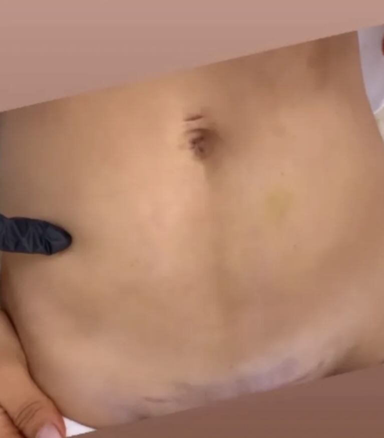Barby Franco mostró el tratamiento estético que se hizo tras el parto de Sarah Burlando: rostro, abdomen y cicatrices