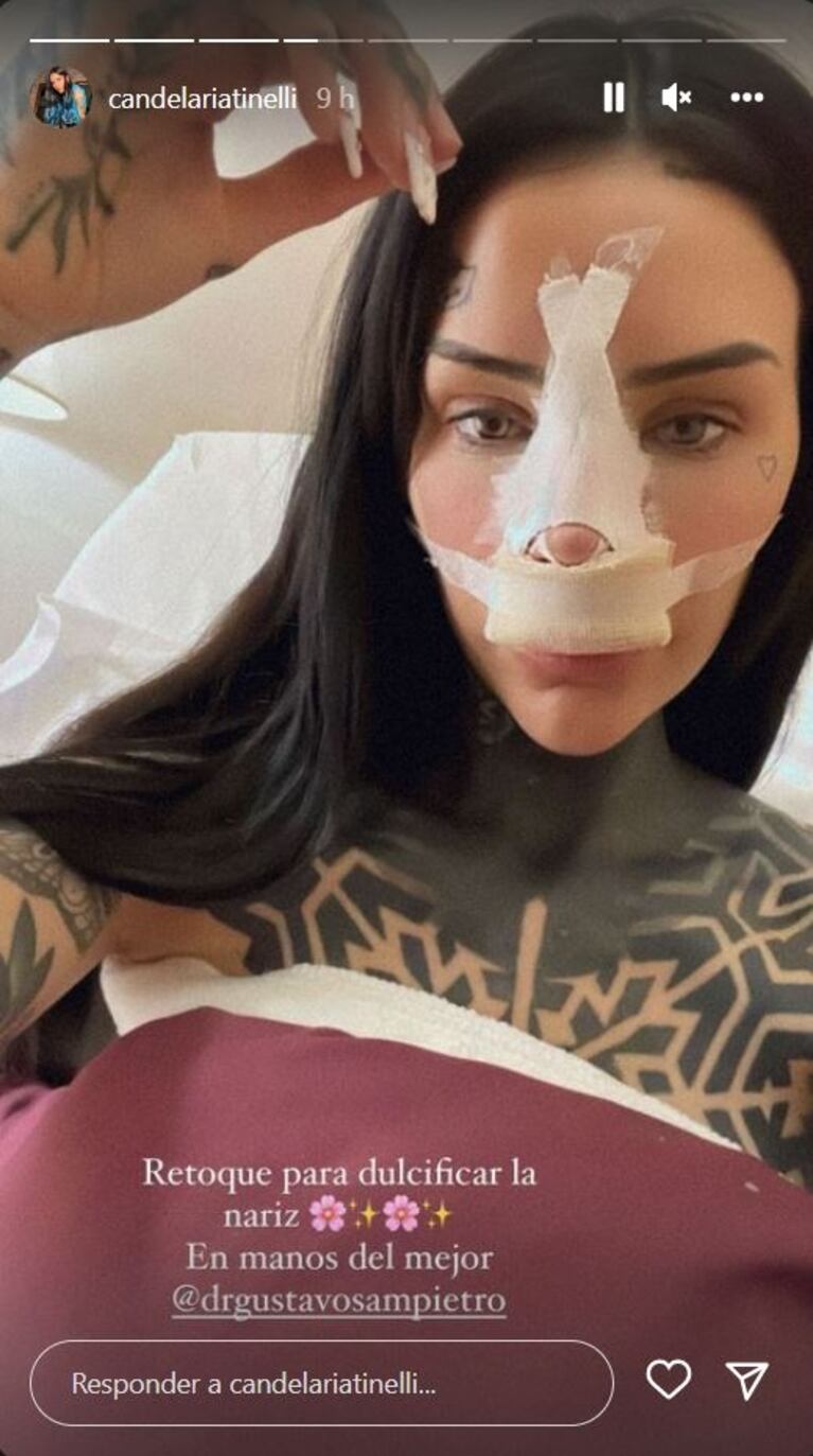 Cande Tinelli se sometió a una cirugía estética y compartió una foto: "Retoque para dulcificar la nariz"