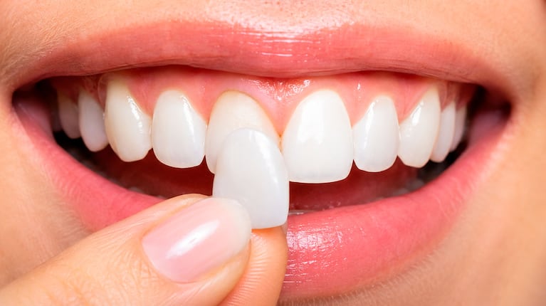Carillas dentales (Foto IA)