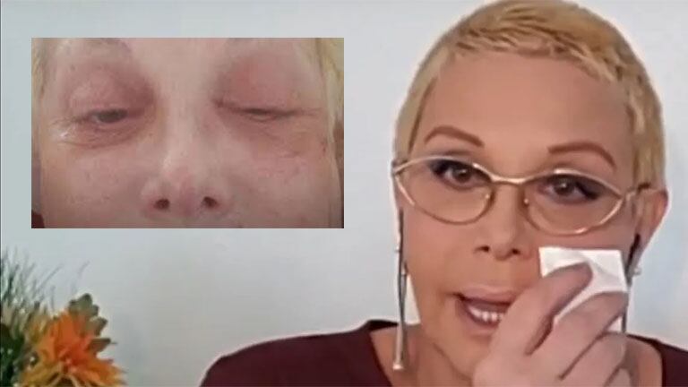 Carmen Barbieri contó su traumática afección con el herpes zóster: Todavía no tengo la cara de antes