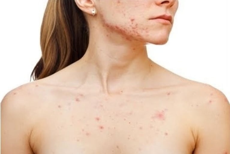 Causas del acné en distintas zonas del cuerpo