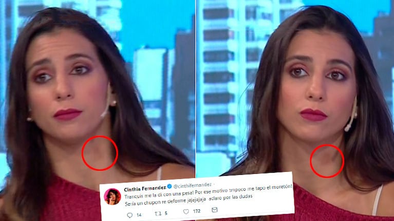 Cinthia Fernández explicó su llamativa marca en el cuello