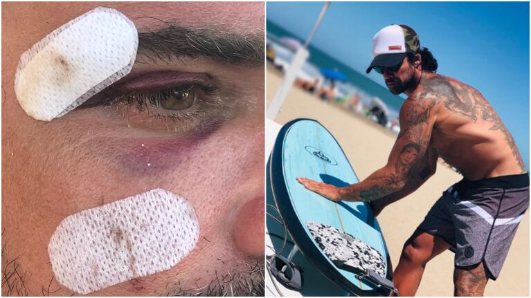 El accidente de Luciano Castro y sus fotos de cómo quedó su cara: ¡Golpazo con la tabla de surf!