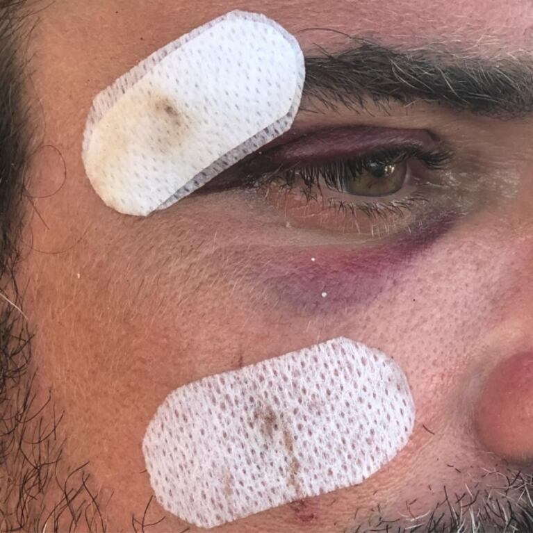 El accidente playero de Luciano Castro, que mostró cómo quedó su cara: "¡Golpazo con la tabla de surf!"