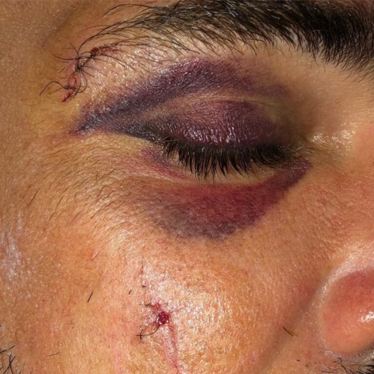 El accidente playero de Luciano Castro, que mostró cómo quedó su cara: "¡Golpazo con la tabla de surf!"