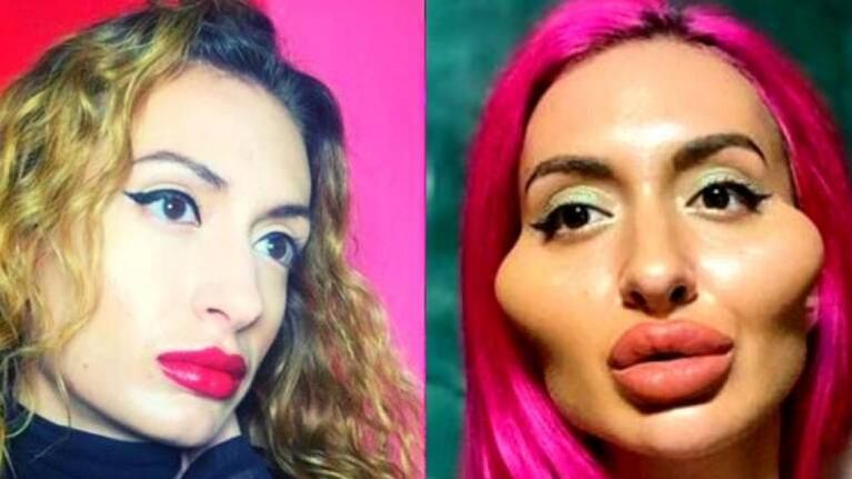 El antes y después de una modelo ucraniana obsesionada con sus pómulos