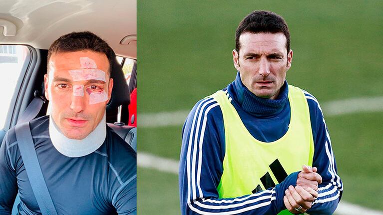 El DT de Argentina, Lionel Scaloni, fue atropellado en España, sufrió lesiones leves y ya fue dado de alta