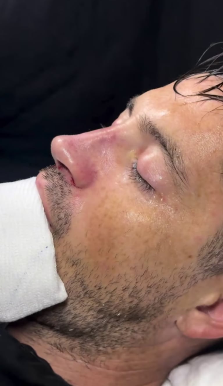 El ex Gran Hermano que decidió operarse la nariz y mostró el impactante antes y después | Créditos @jpdevi