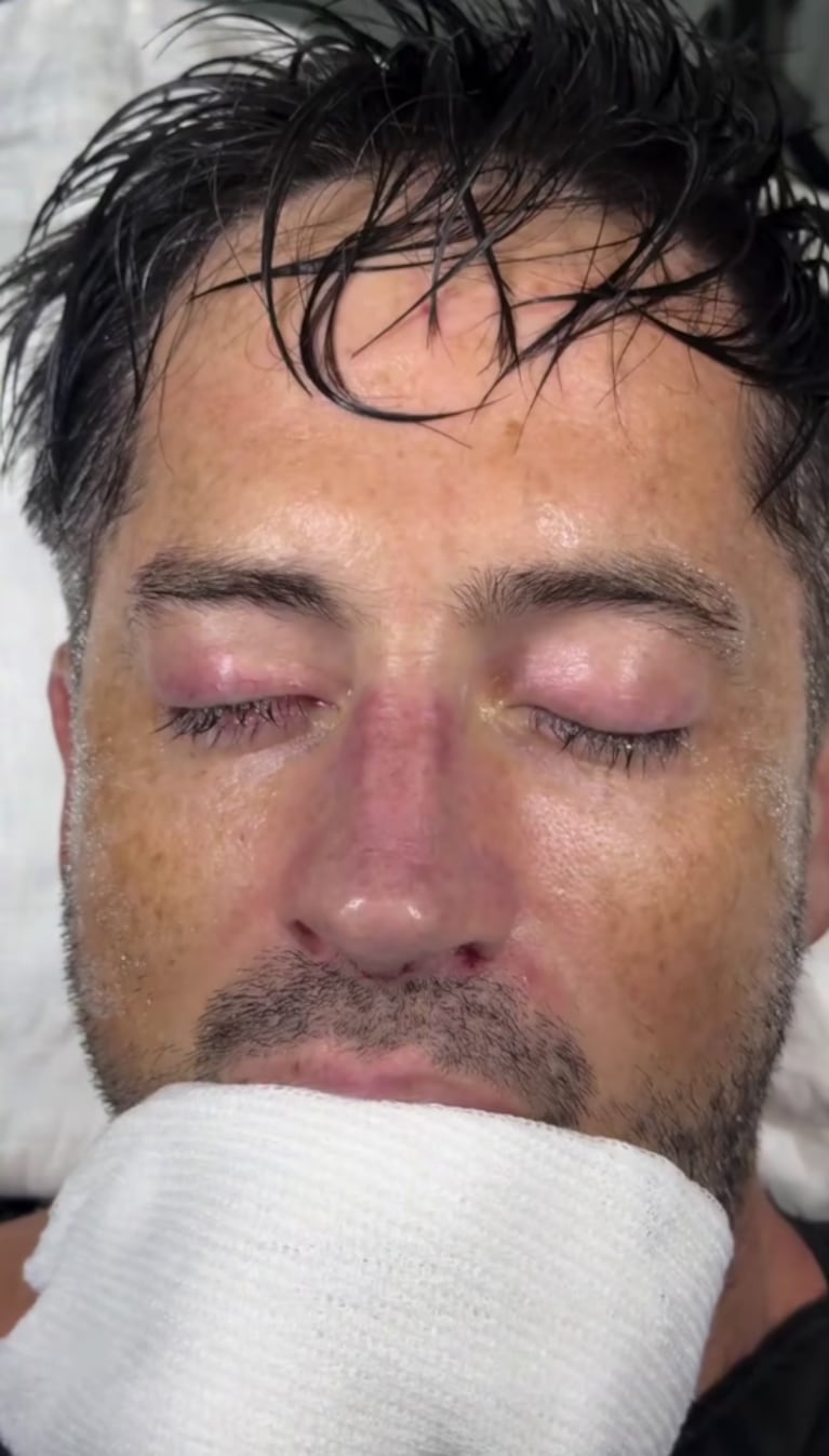 El ex Gran Hermano que decidió operarse la nariz y mostró el impactante antes y después | Créditos @jpdevi