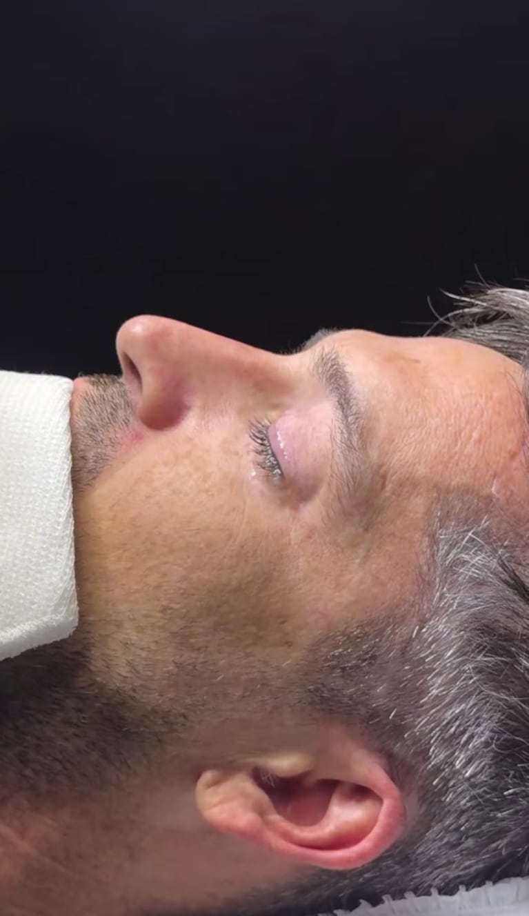 El ex Gran Hermano que decidió operarse la nariz y mostró el impactante antes y después | Créditos @jpdevi