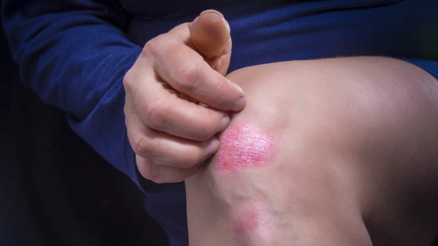 Espiá estos consejos para minimizar los efectos de la psoriasis