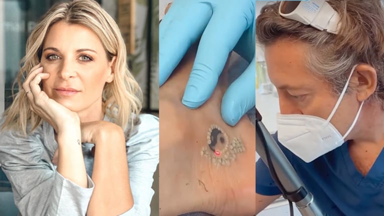 Eugenia se está removiendo un tatto que se hizo en el pie, cerca del talón.