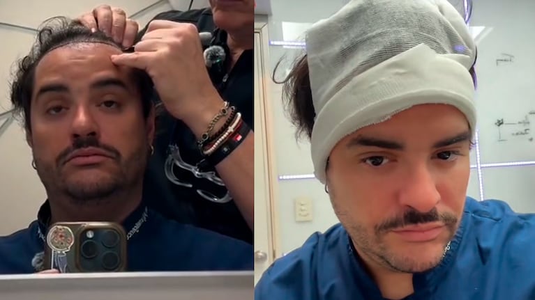 Homero Petinatto se hizo un tratamiento capilar y lanzó una divertida chicana a los pelados (Captura de Instagram)