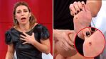 Mariana Brey mostró su verruga plantar en Los Ángeles de la Mañana