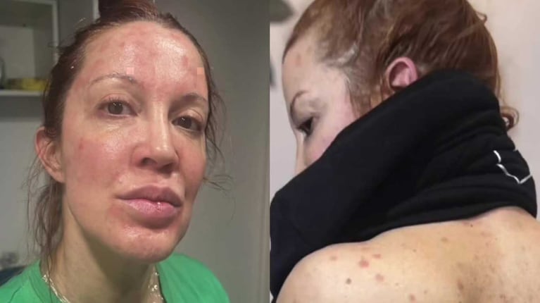 “Dormía envuelta en papel film”: Miriam Lanzoni y el duro relato sobre su salud