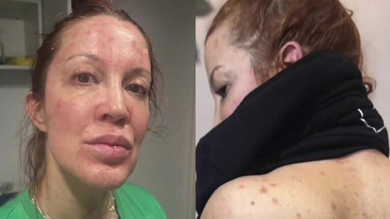 “Dormía envuelta en papel film”: Miriam Lanzoni y el duro relato sobre su salud
