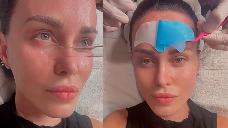 Natalie Weber se puso hilos tensores en la cara y mostró el el antes y el después
