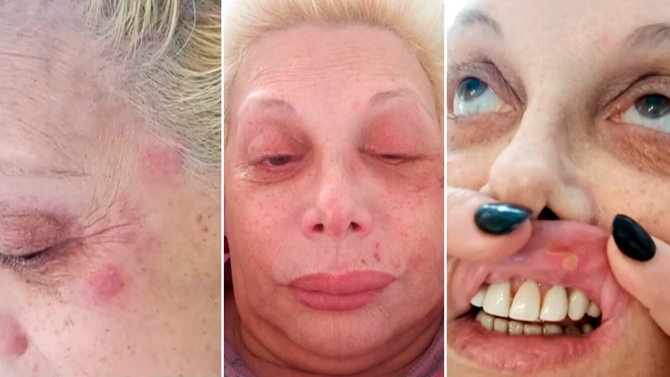 Tremendas imágenes de Carmen Barbieri afectada por un herpes zóster que le deformó la cara: "Soy un monstruo"