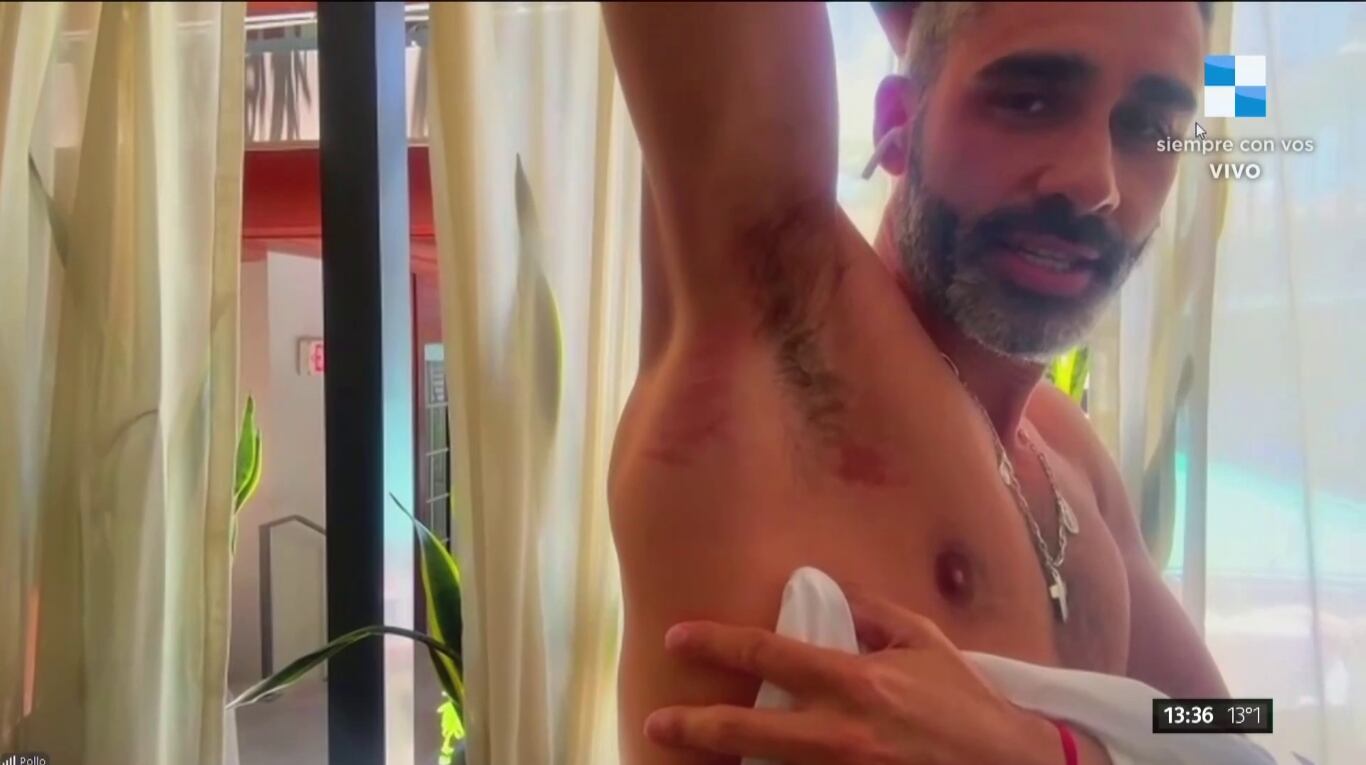 El Pollo Álvarez sufrió un grave accidente al caer de un escenario en Miami y mostró sus lesiones en vivo