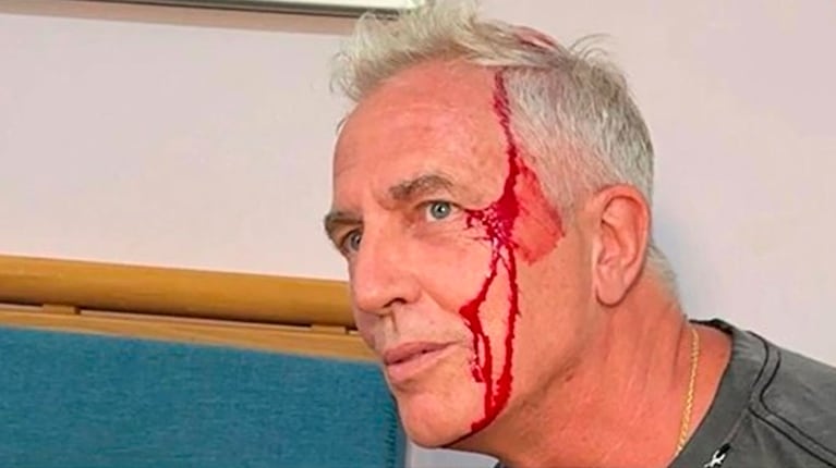 Marley tuvo un dramático accidente en Tailandia: “Quedé bañado en sangre y casi me desmayo”