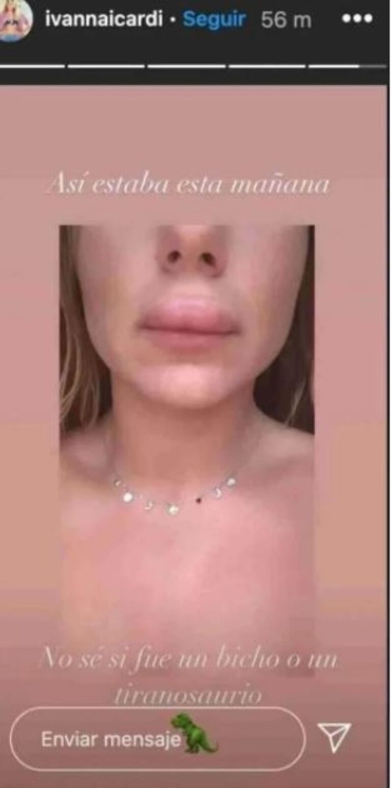 Ivana Icardi mostró la tremenda deformación en su rostro por una picadura: "No sé si fue un bicho o un tiranosaurio”