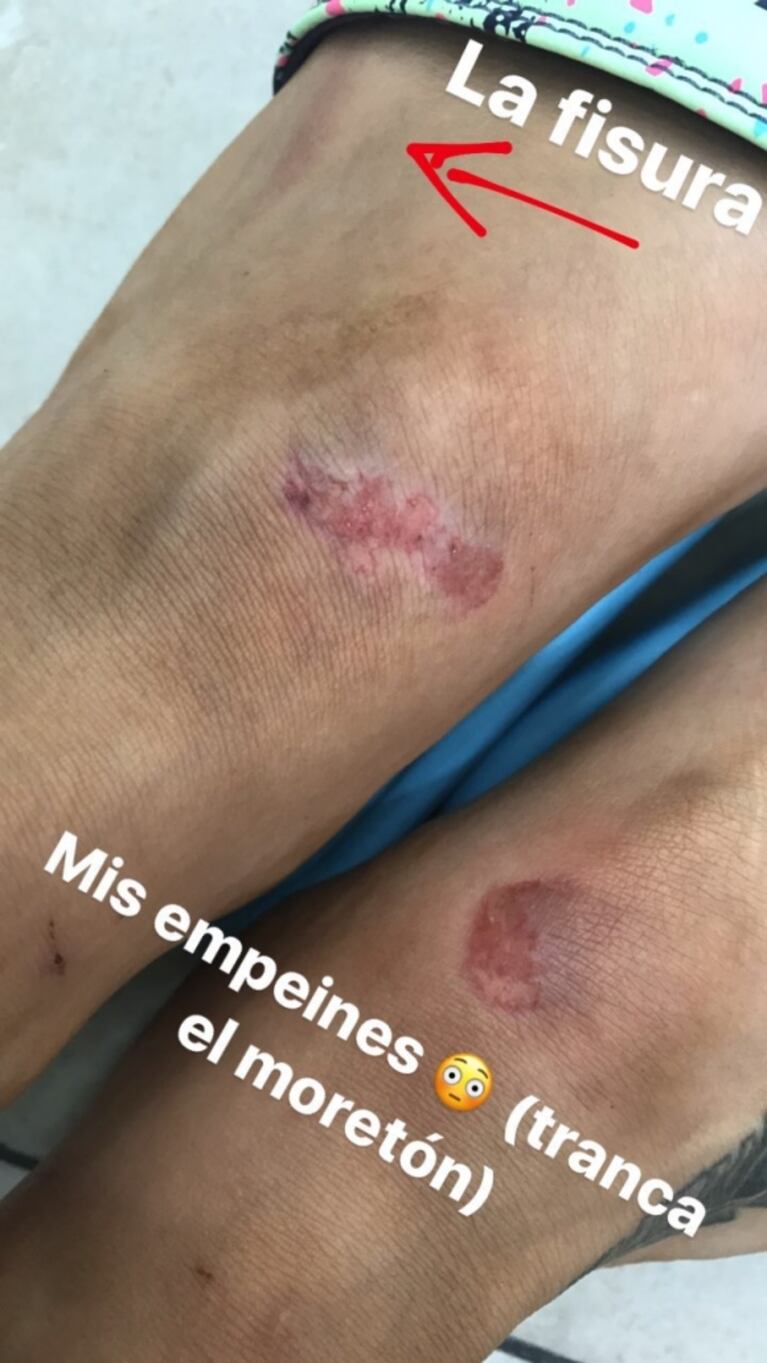 Jimena Barón mostró las fotos de los tremendos moretones que le dejó la salsa de a tres en Bailando 2017... ¡y mirá cómo la mimó Del Potro!