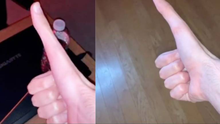Joven con pulgares de 12 y 11 centímetros revoluciona TikTok