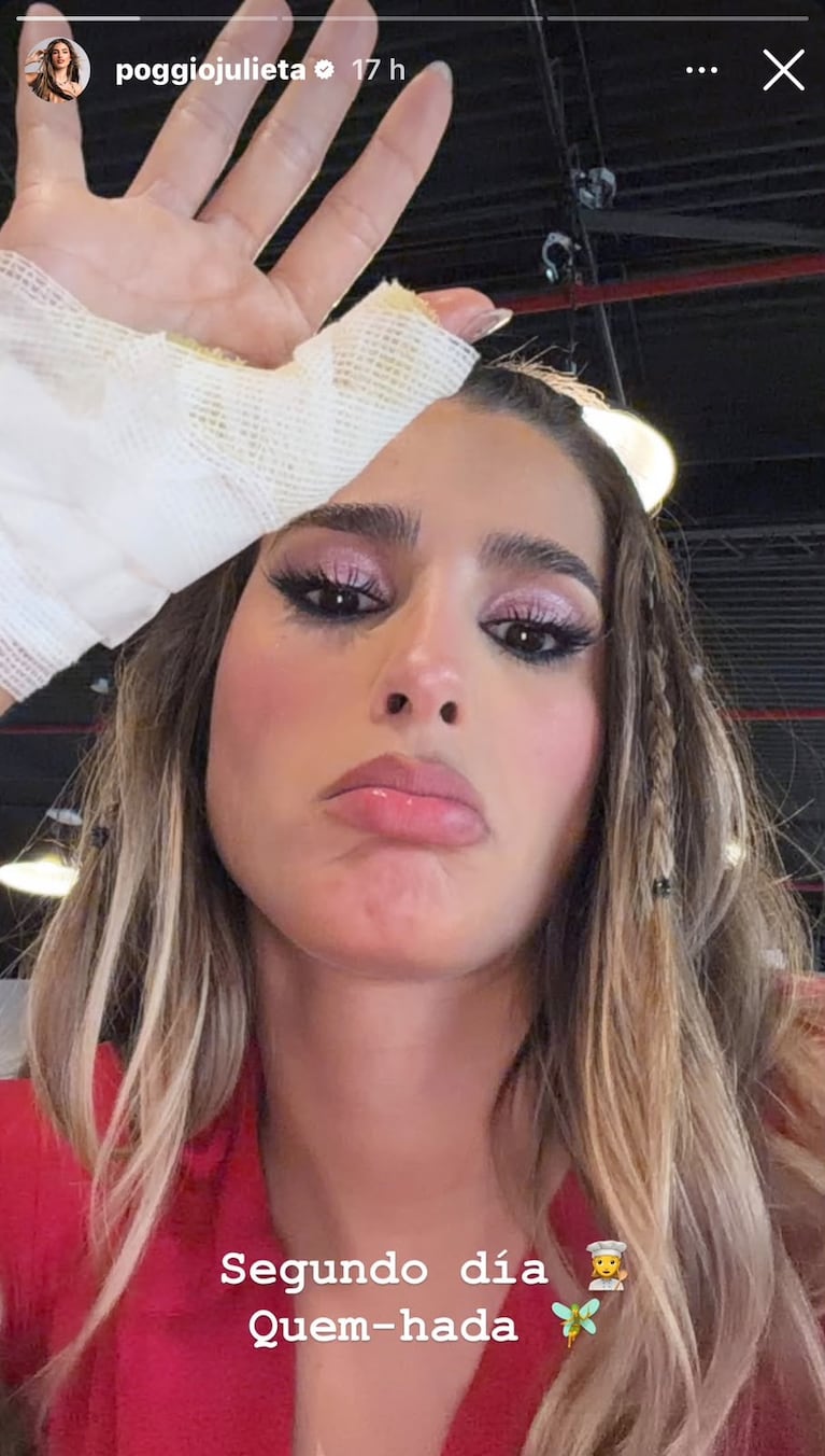 Julieta Poggio mostró cómo quedó su mano tras quemarse en Masterchef Celebrity (Foto: Instagram/@poggiojulieta).