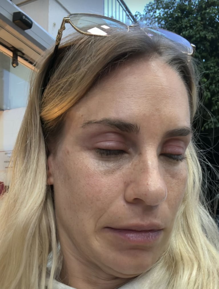 Julieta se burló de sí misma por haberse quemado los párpados.