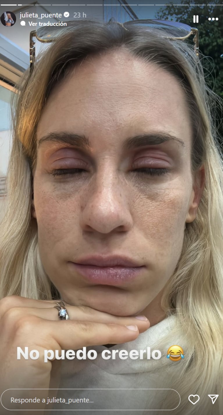 Julieta se quedó dormida al sol y se le quemaron los párpados.
