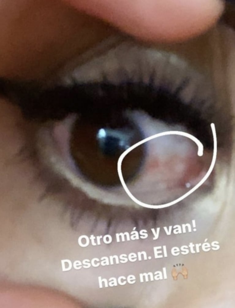 Karina La Princesita mostró la consecuencia que sufrió por no descansar bien: "El estrés hace mal"