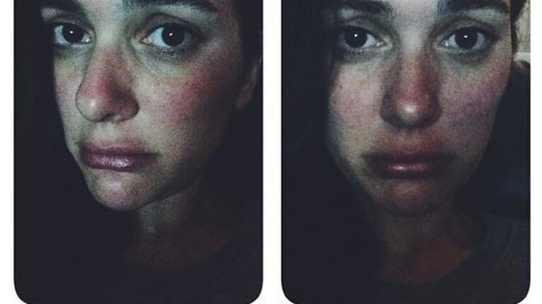 La alergia que mostró Sherezade en Instagram.
