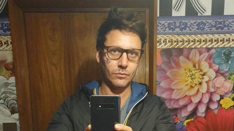 La cicatriz de Benjamín Vicuña | Créditos: Instagram @benjaminvicuna.ok