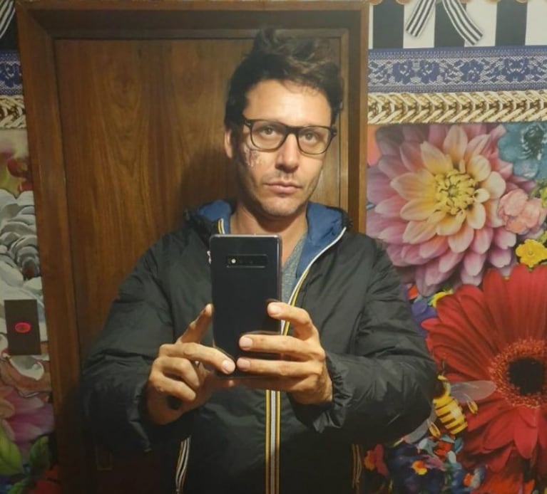 La cicatriz de Benjamín Vicuña | Créditos: Instagram @benjaminvicuna.ok