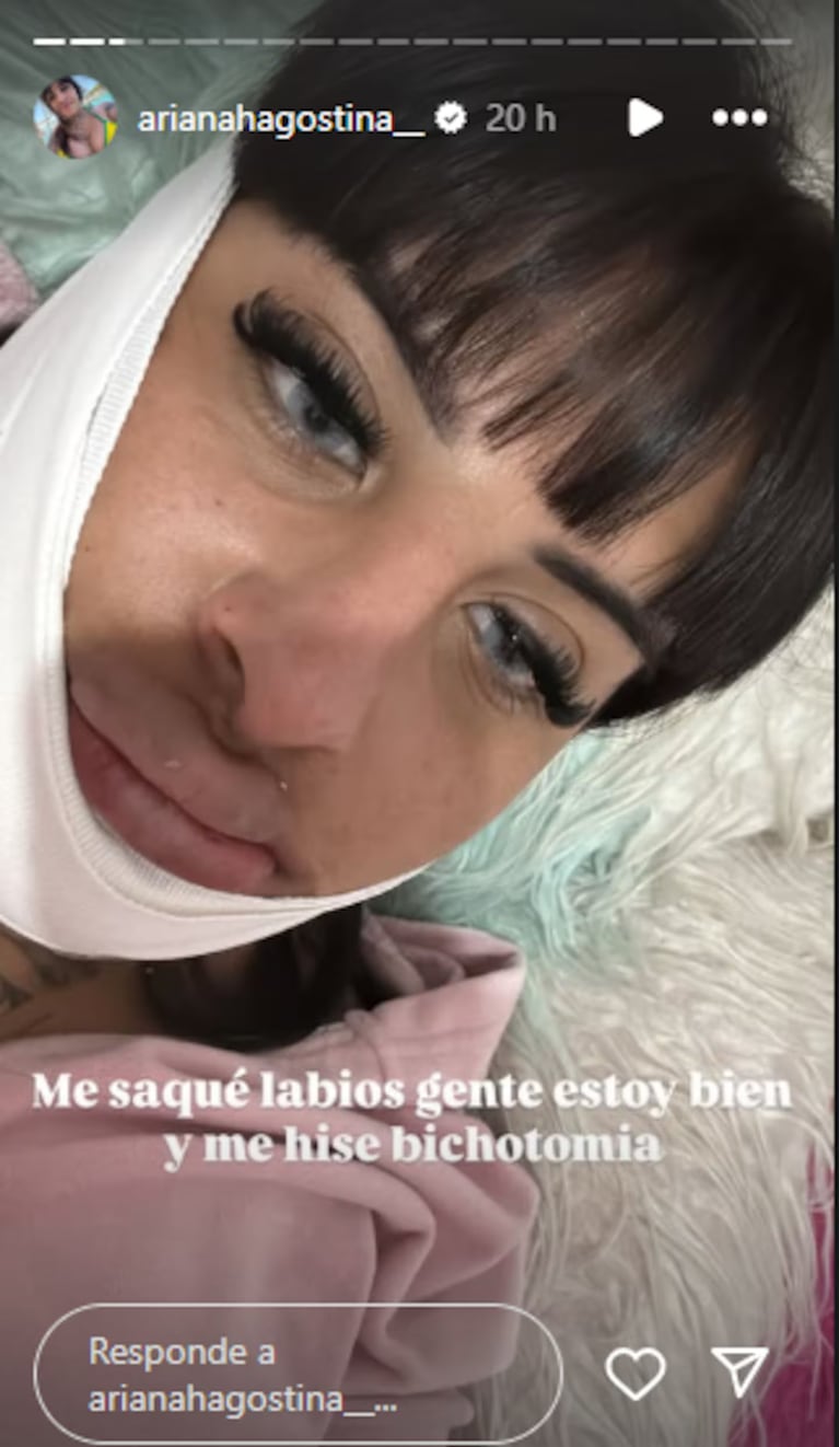 La Coqueta se sacó el ácido hialurónico de los labios y mostró el resultado. Crédito: Instagram