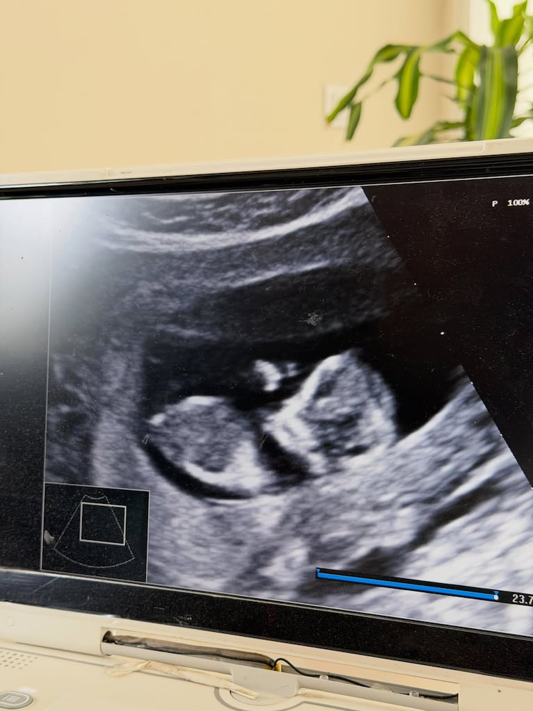 La imagen en 3D fue la elegida por Daniela como su foto favorita de la primera ecografía. Fuente: Instagram @danibatllecasas