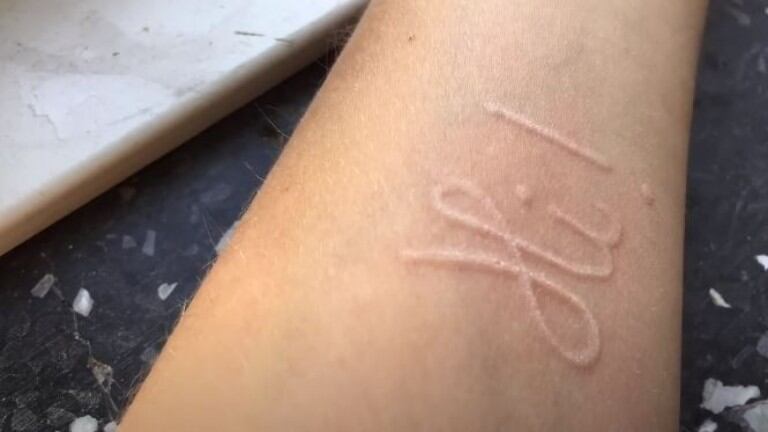 La rara afección cutánea de esta joven la convierte en un lienzo humano